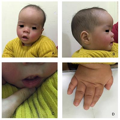 Growth Concerns in Coffin–Lowry Syndrome: A Case Report and Literature Review